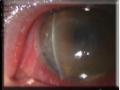 Serious eye infections can be caused by hot tubs or swimming pools with your contacts in!