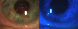 marginal infiltrative keratitis