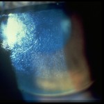 GP lens with scratches and deposits